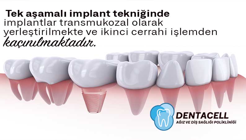 Tek Aşamalı İmplant Nedir? ⋆ Dentacell Ağız ve Diş Sağlığı Polikliniği